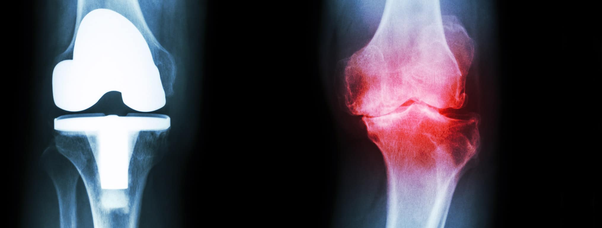 Osteoarthritis | Causes, Symptoms, & Treatment for Arthritic Pain