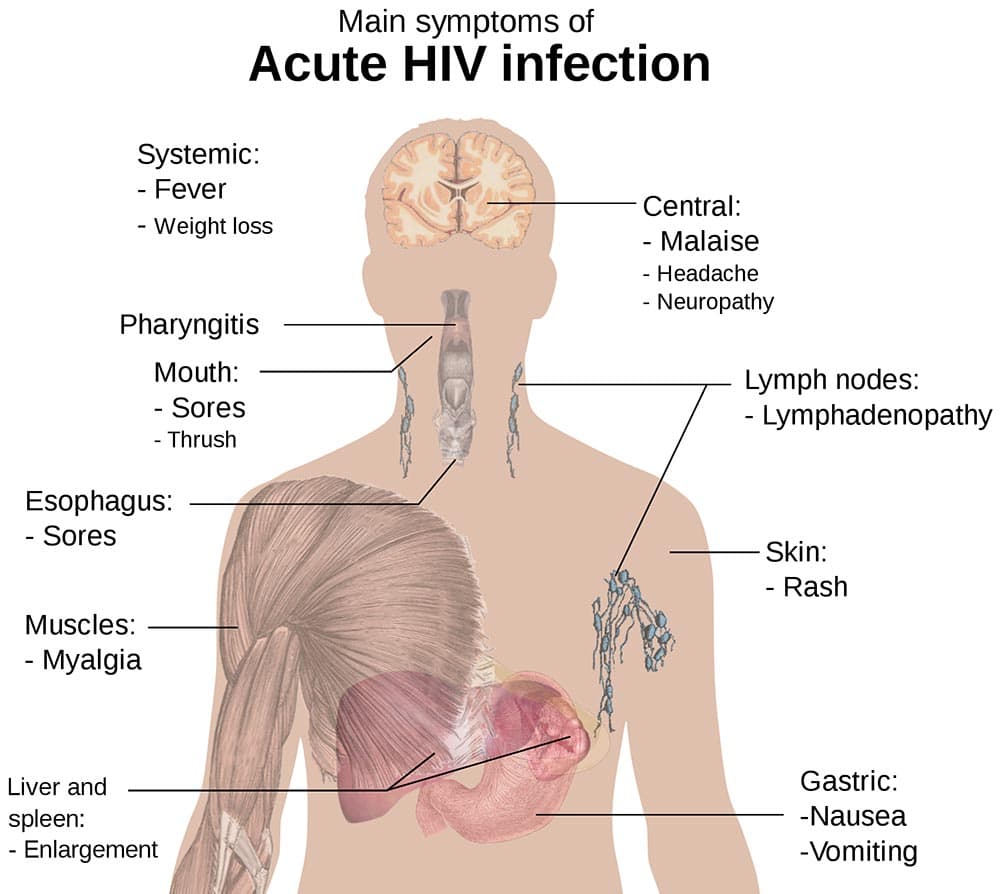 acute HIV paresthesia