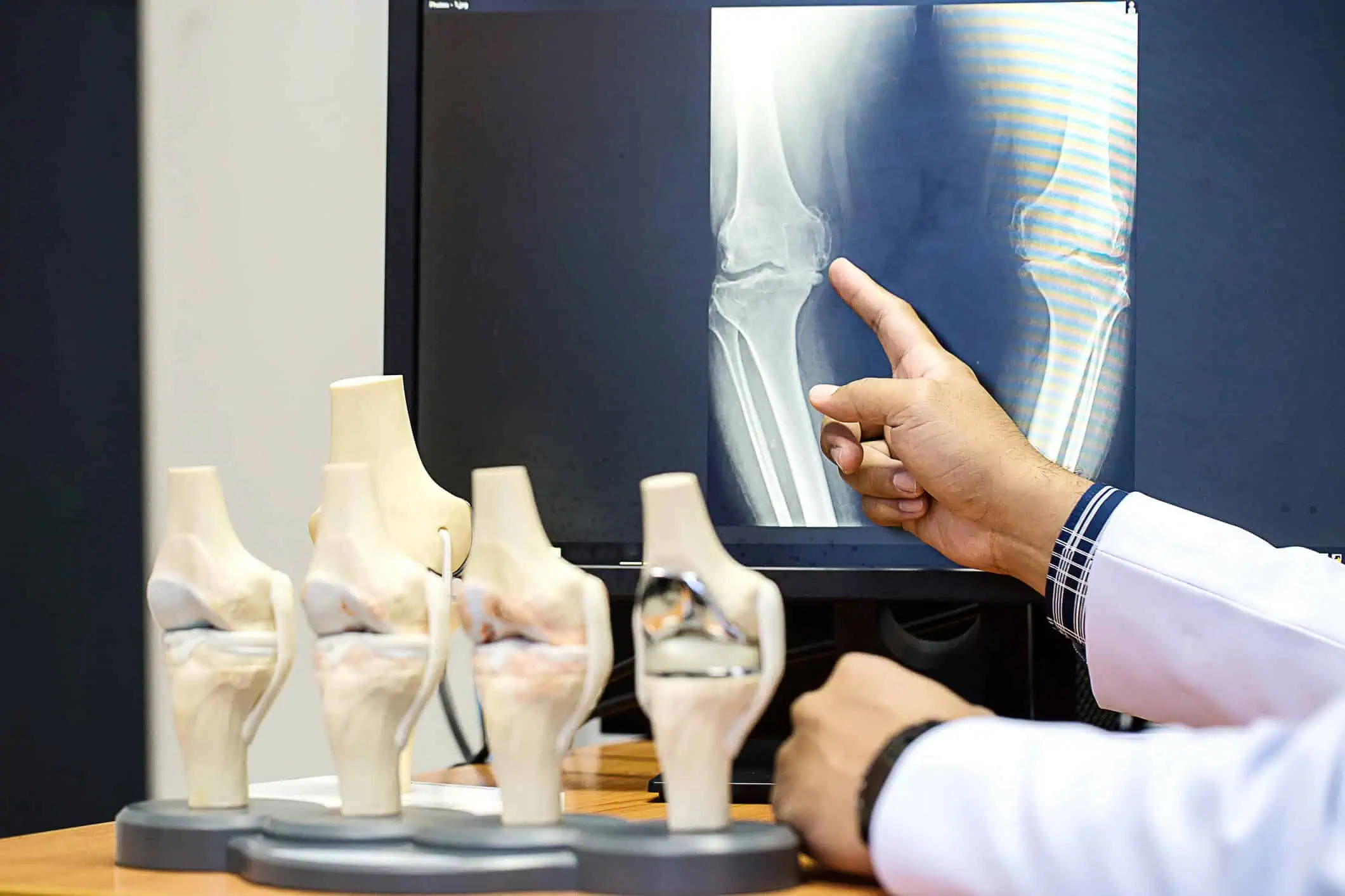 What is the Success Rate of Stem Cell Therapy for Knees?